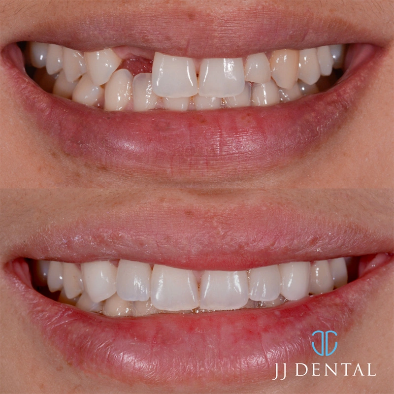 Dental implant before and after — case 1
