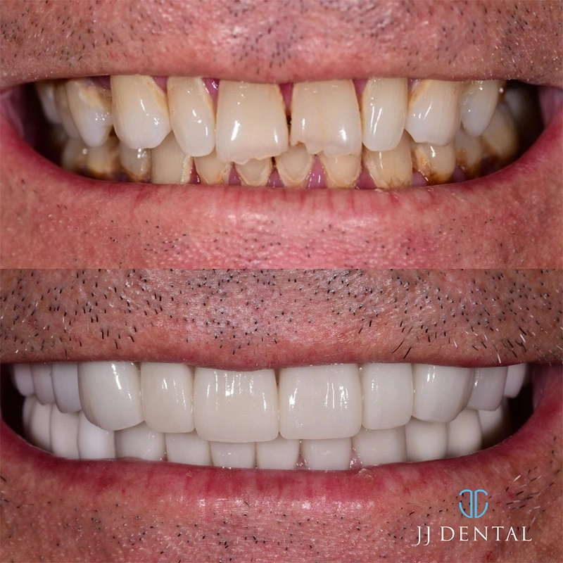 Dental implant before and after — case 3